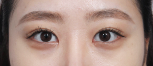 How to Reduce Eye Bags and Dark Circles