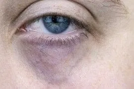 Vascular Circles