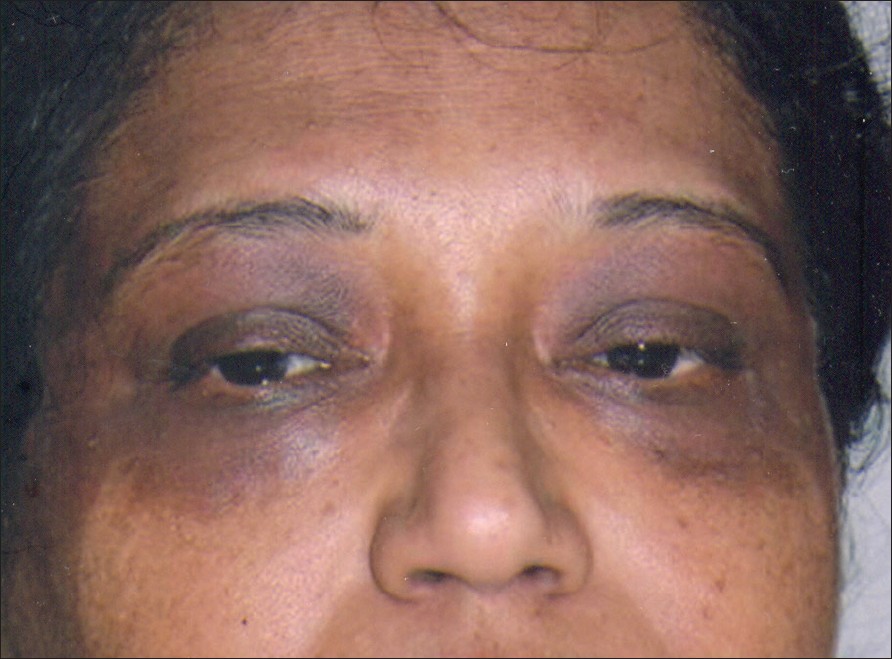 Pigmented Dark Circles 