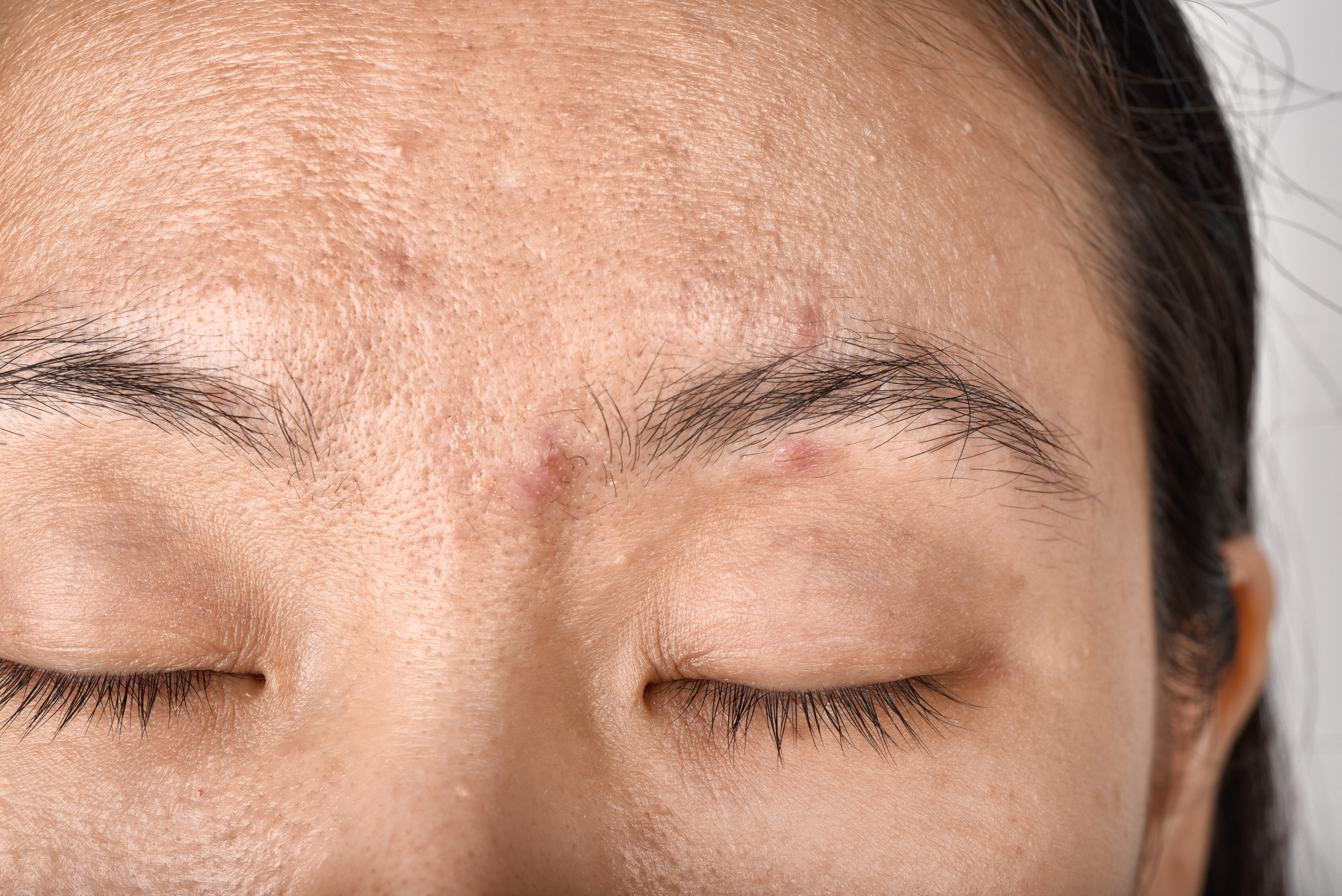 Who Benefits Most from Subcision