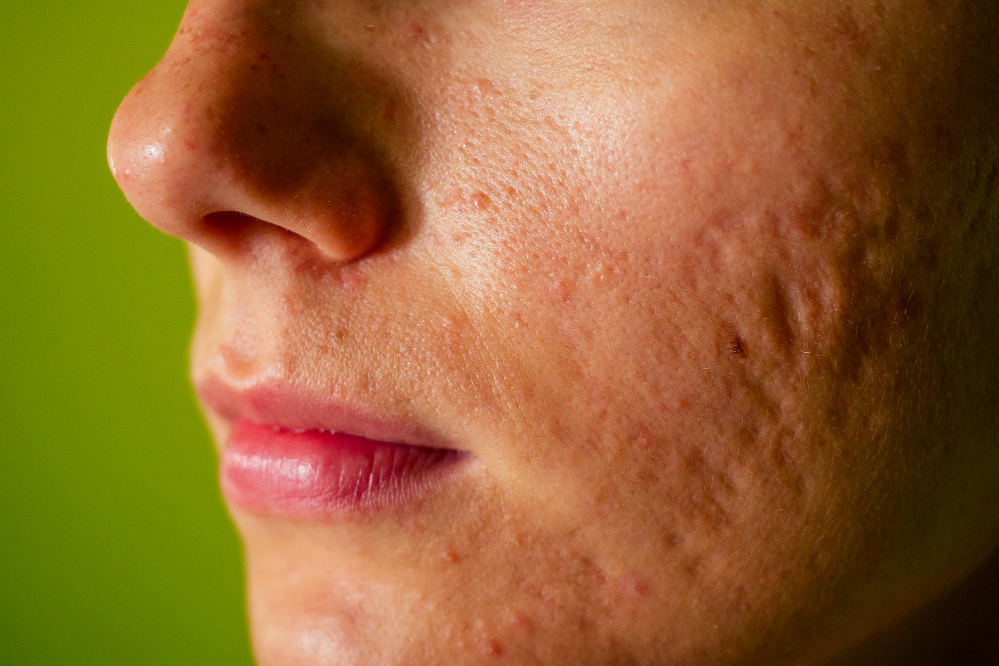 How Subcision Acne Scars Treatment Actually Works