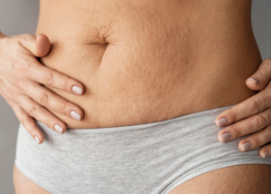 Self-Conscious About Stretch Marks? Laser Treatment Could Change That